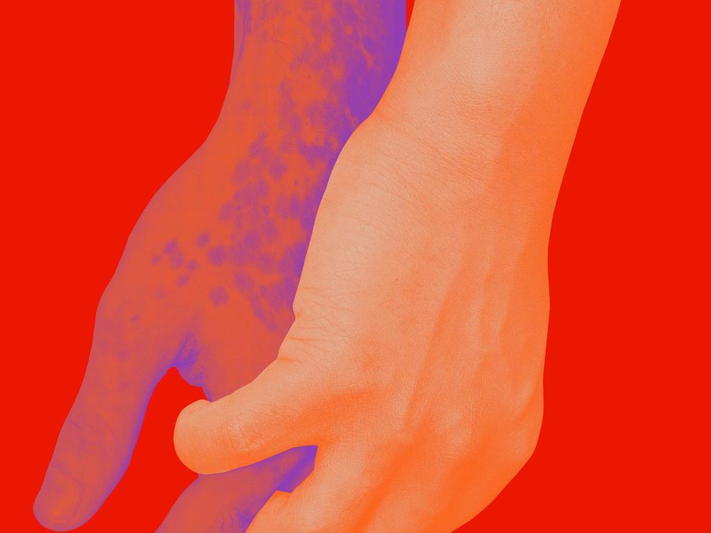 JJ Bodyillustration Exterior Claspedhandsvitiligo Colorway01