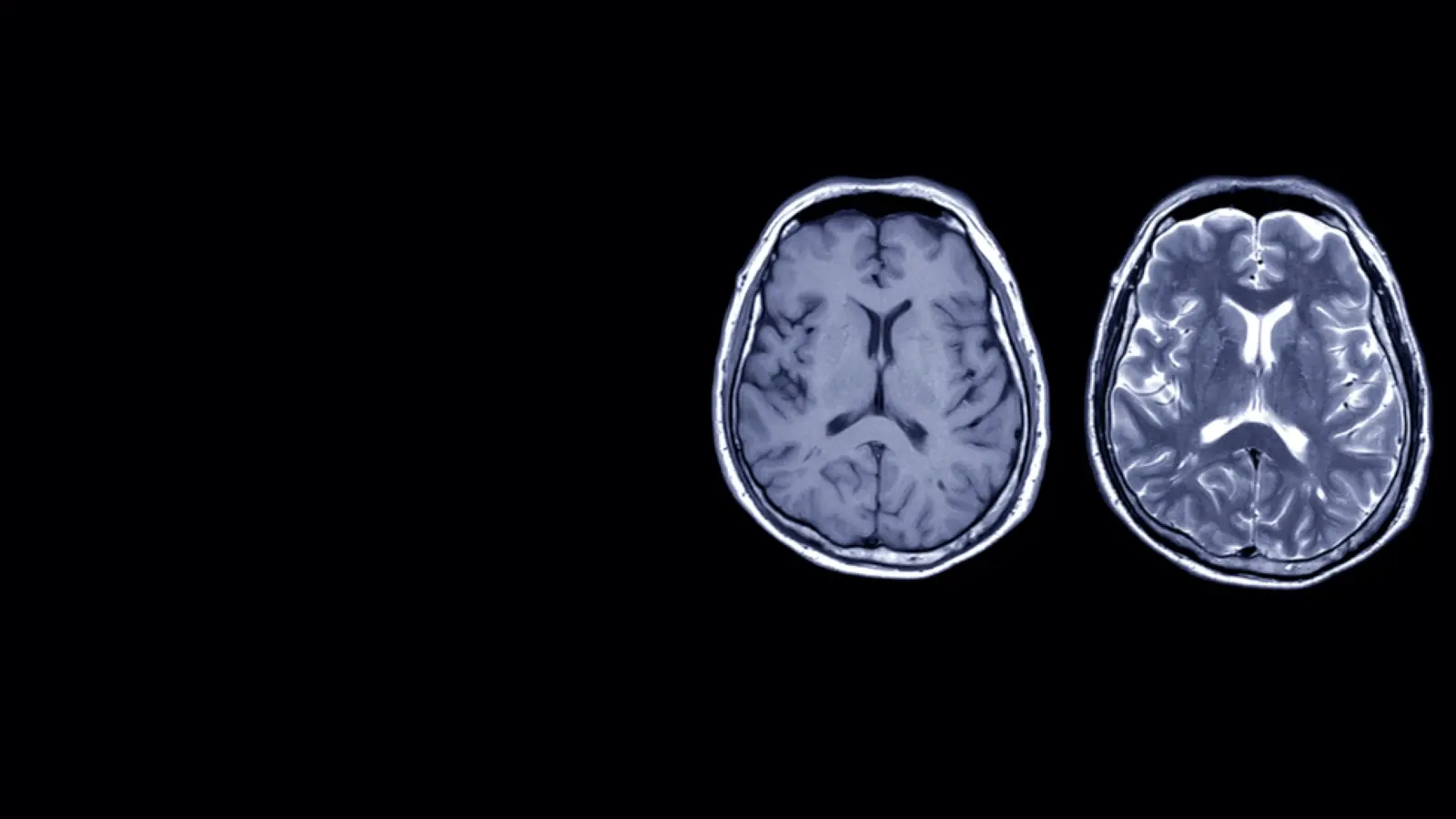 View of an axial slice of a human brain using Magnetic Resonance Imaging (MRI) technology