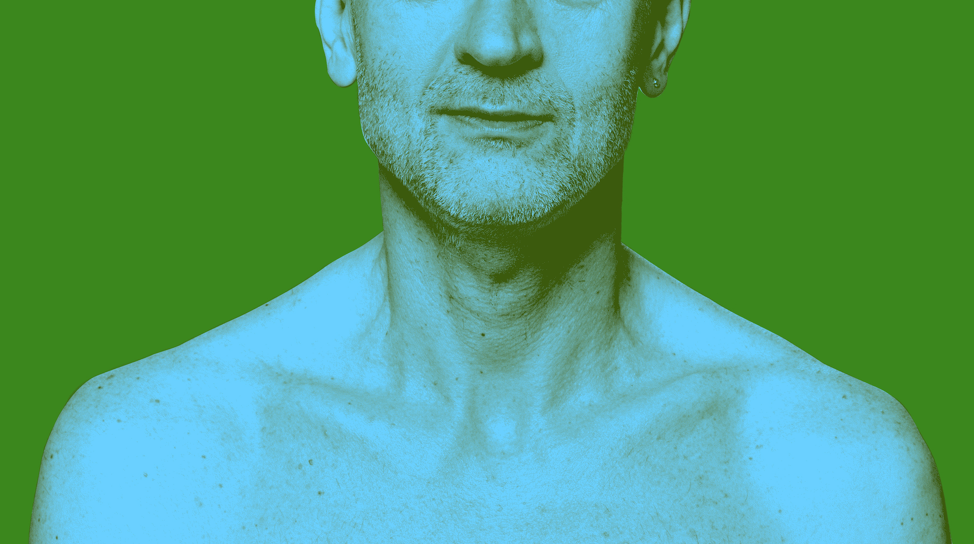 Myasthenia Gravis