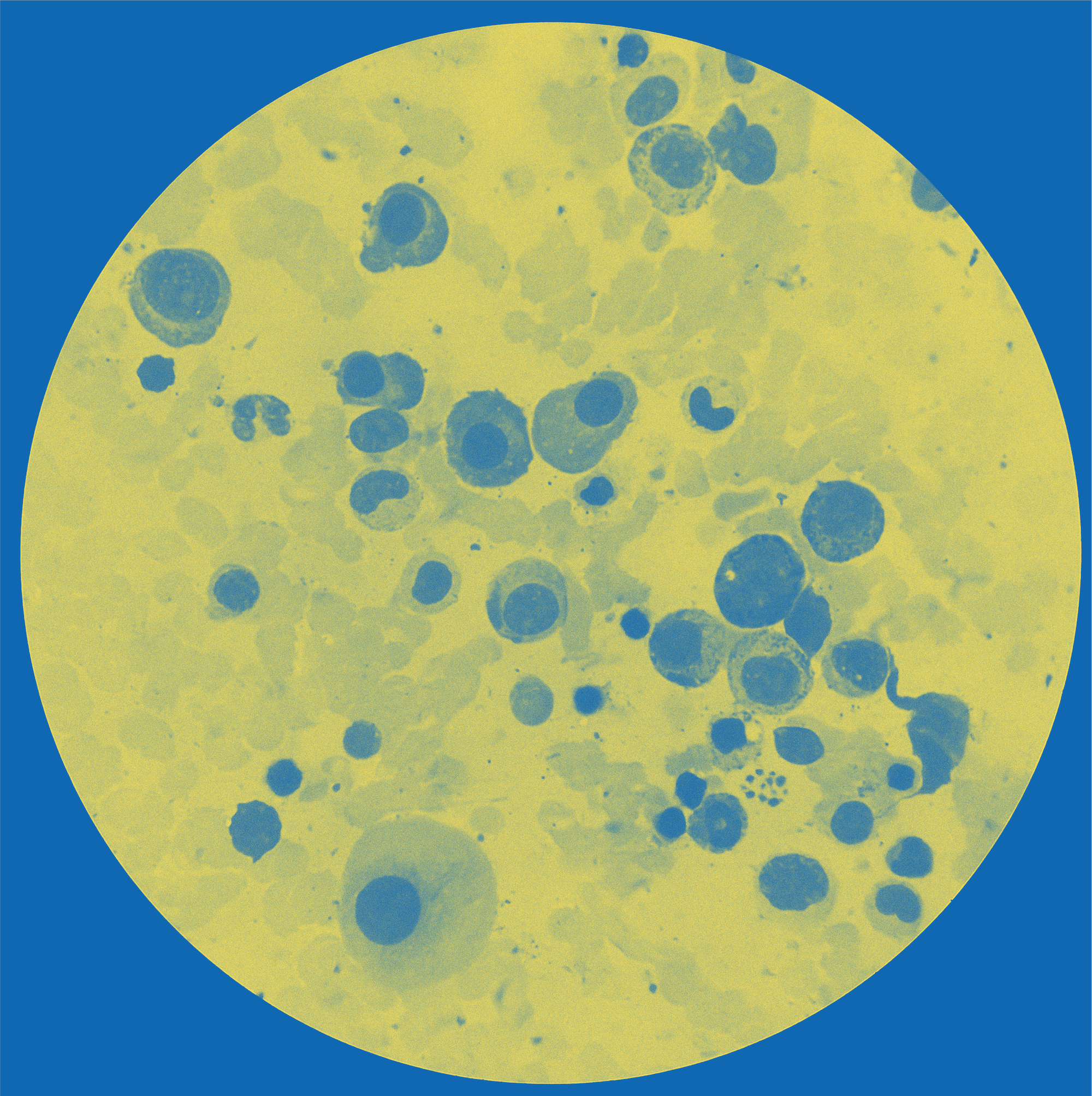 Myeloid Malignancies