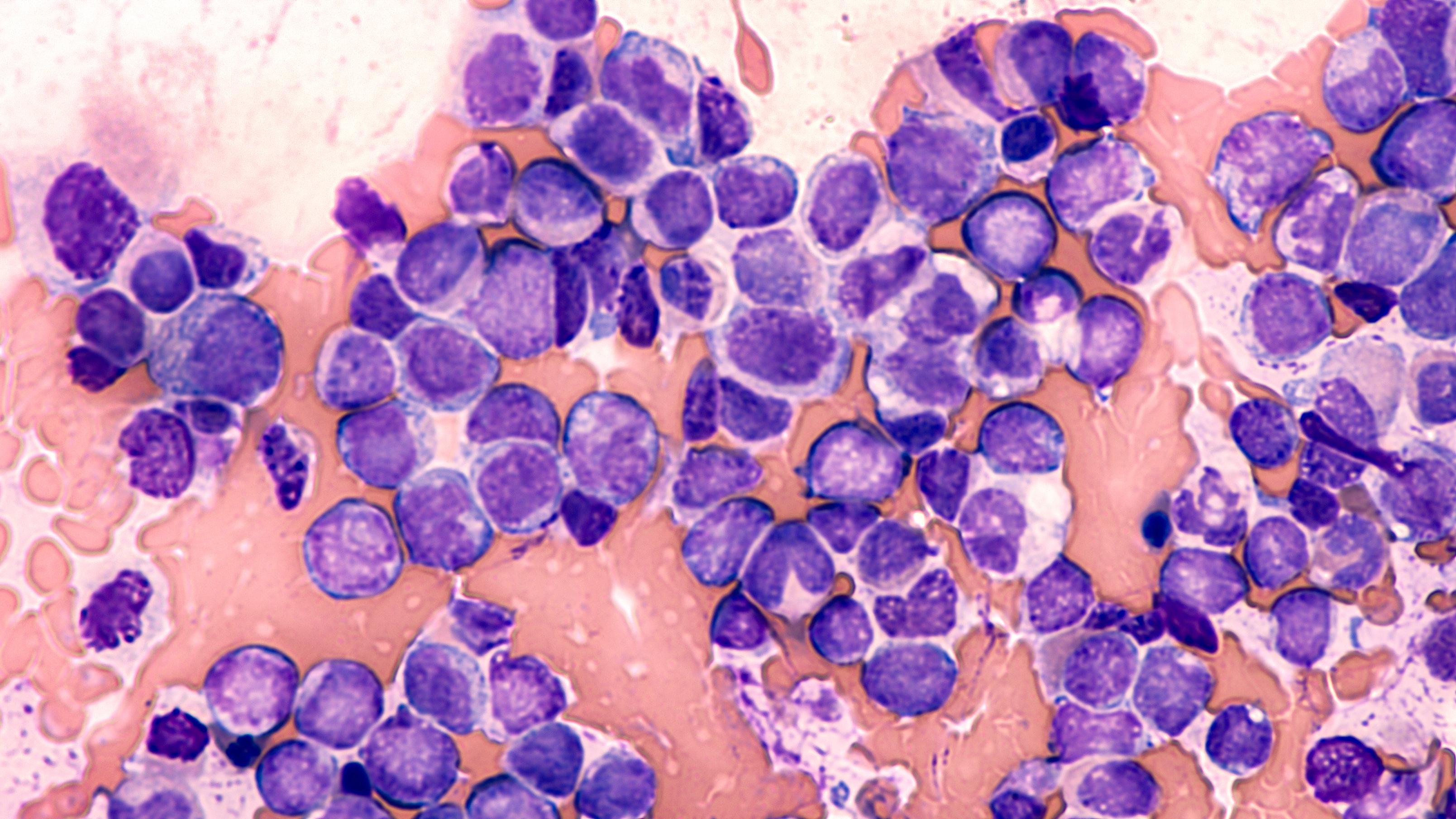 JJ Photo Blast Cells From Acute Myeloid Leukemia AML Shutterstock 574965784 1Star