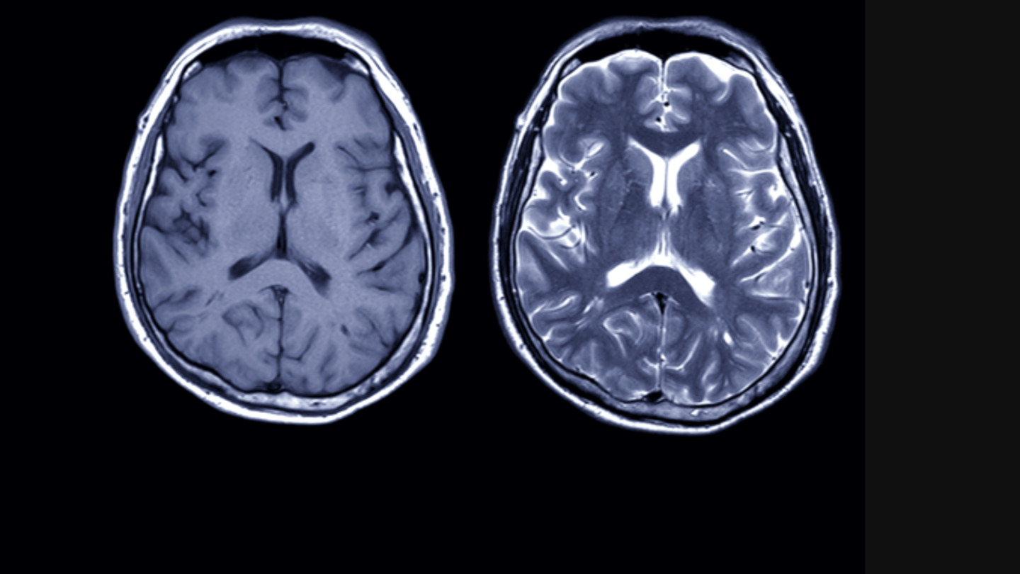 One data scientist's mission to decode Alzheimer’s at J&J