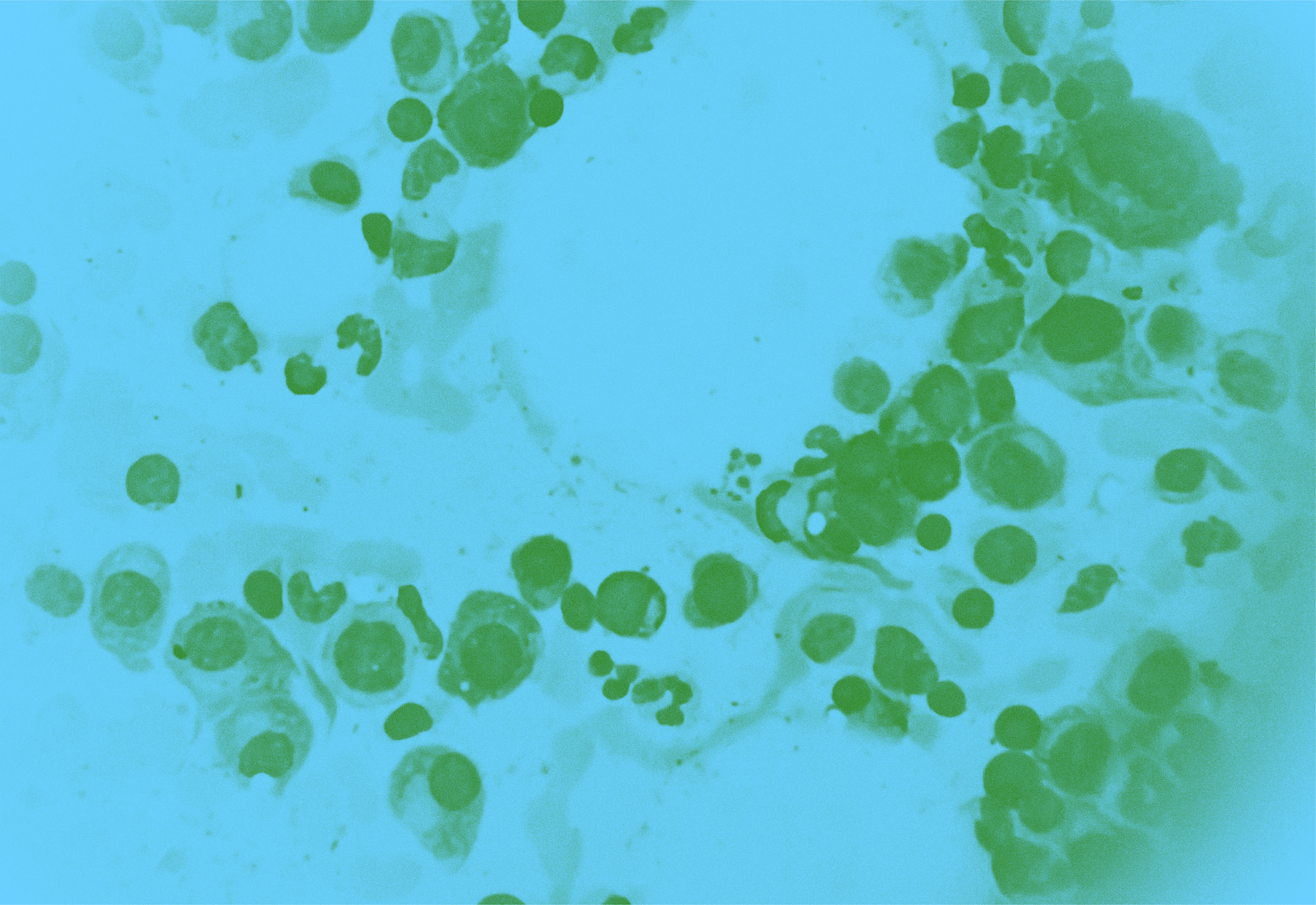 Multiple Myeloma